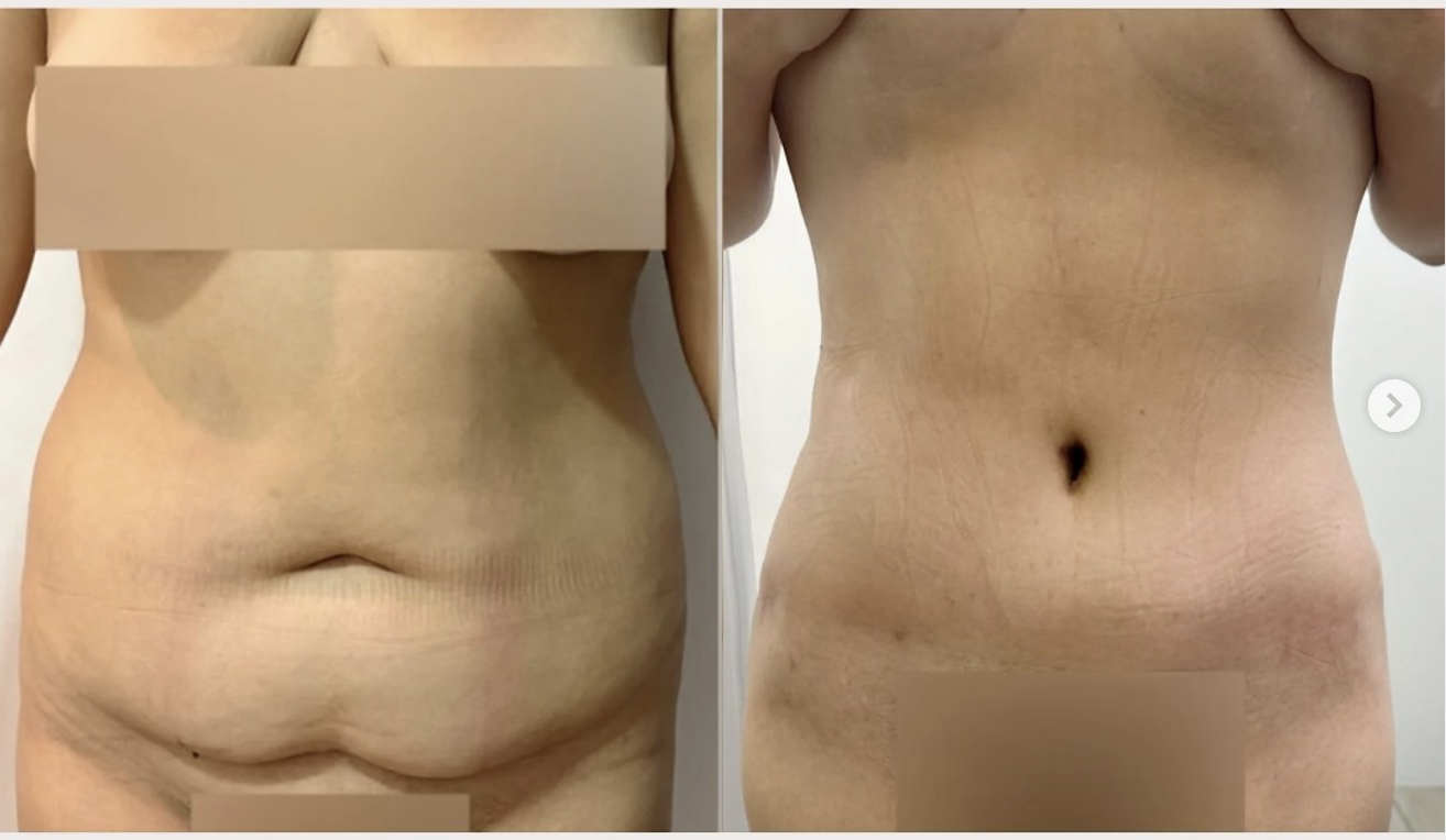 Abdominoplastia resultado