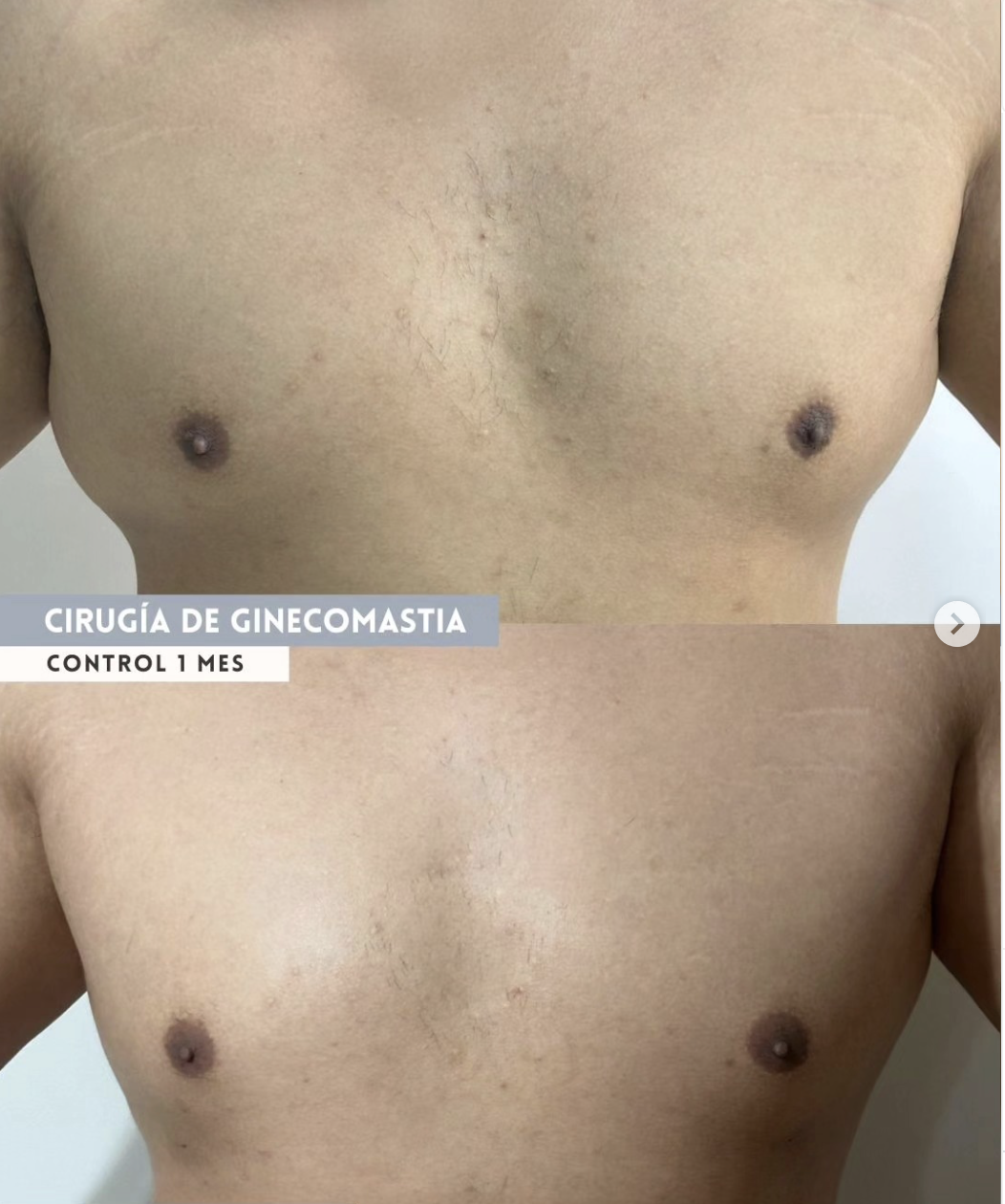 Ginecomastia resultado
