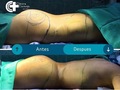 Gluteolift