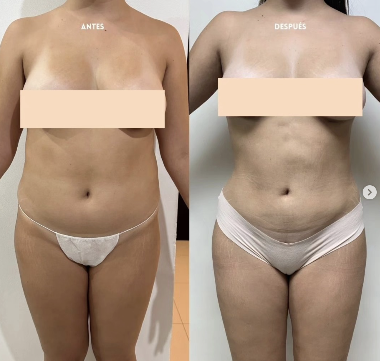 Lipoescultura resultado