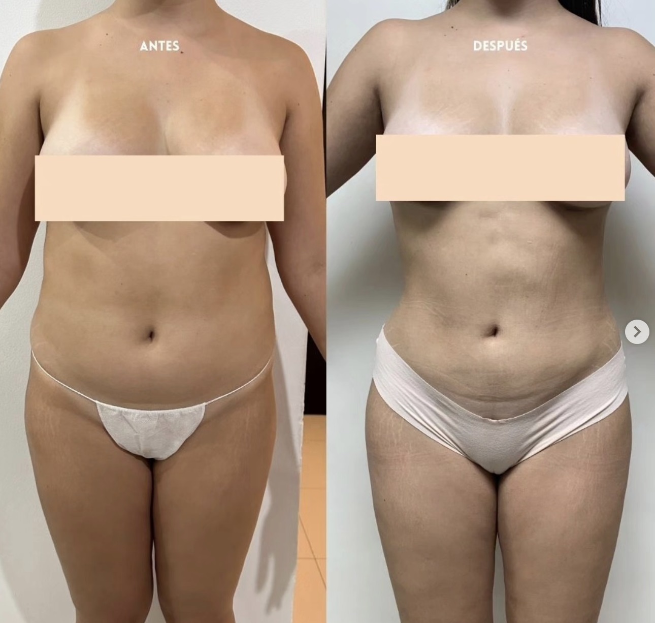 liposuccion