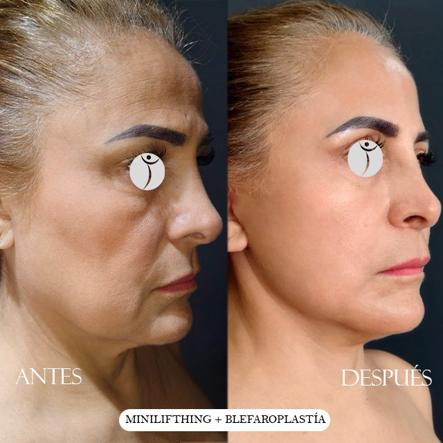 Lifting resultado